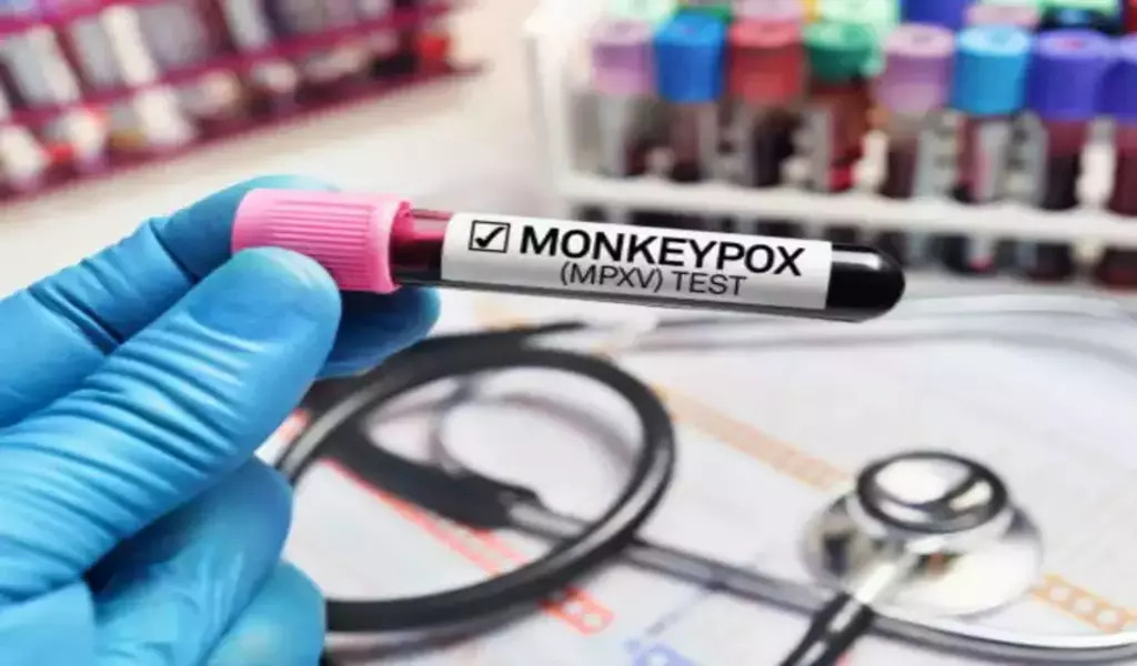Monkeypox is a rare disease caused by infection of Monkeypox virus, which grows and spreads rapidly. The World Health Organisation (WHO) has declared, Monkeypox epidemic – a global health emergency. Symptoms for the same may start out as a fever, swollen lymph nodes, headache, and muscle aches, followed by a rash that starts out as flat and then advances to pimples, or blisters and ulcers on the face, body and private parts (sexual organs).  According to the latest data from WHO, 14000 cases are confirmed worldwide. Further, Four cases of Monkeypox have been detected in India out of which three cases are from Kerala and one is the recent case from Delhi.  As per CheckBrand Analysis, in the past seven days, the disease has been searched for 2997 times across the web. It has received around 57.5% negative sentiment and has engagement of 6.9 Million across the globe.